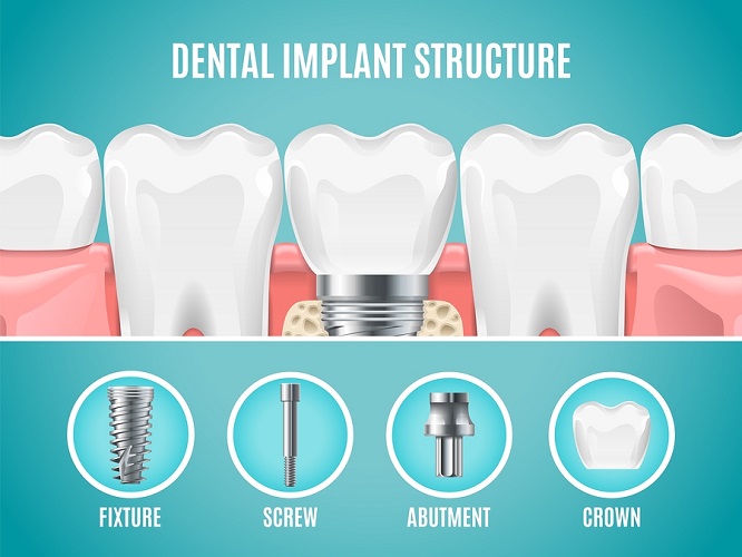 Dental Implant Surgery